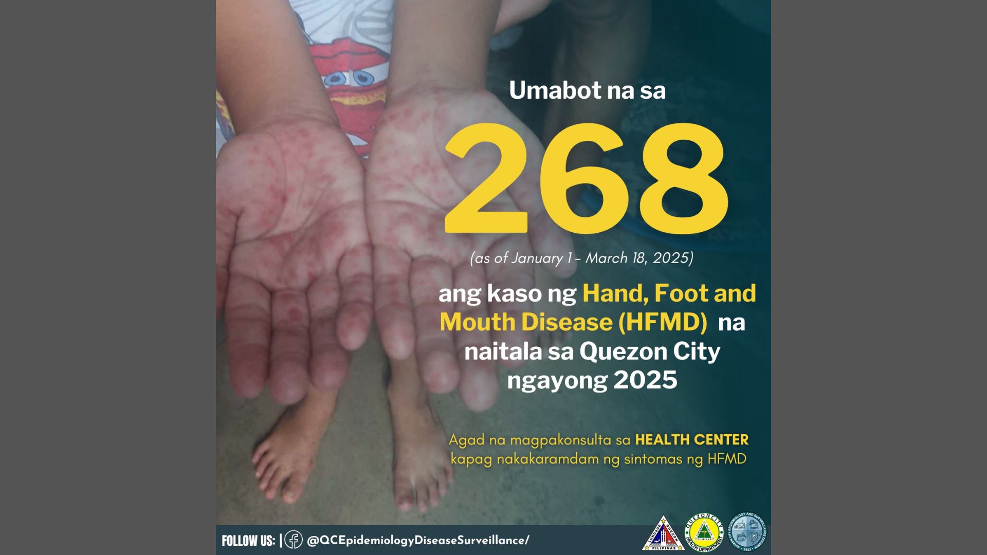 Kaso ng HFMD sa Quezon City umakyat na sa 268