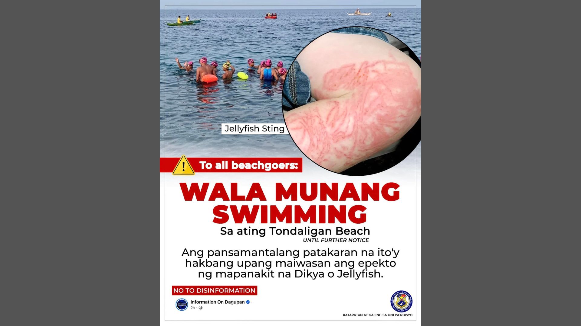 ‘No Swimming Policy’ ipinatupad sa Bonuan Tondaligan Beach sa Dagupan City dahil sa pagtaas ng kaso ng Jellyfish Sting