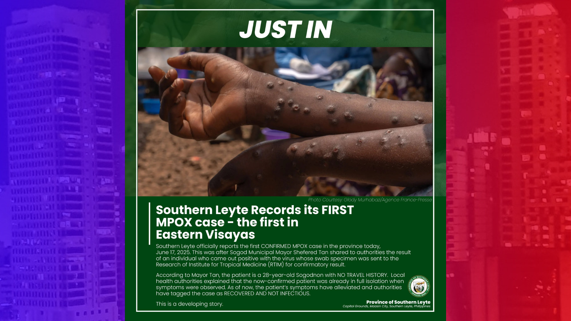 Kaso ng MPOX naitala sa Sogod, Southern Leyte